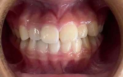 隱形牙套-隱適美Invisalign 隱形牙套-隱適美Invisalign
