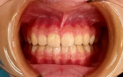 隱形牙套-隱適美Invisalign 隱形牙套-隱適美Invisalign