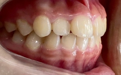 隱形牙套-隱適美Invisalign 隱形牙套-隱適美Invisalign