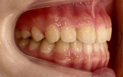 隱形牙套-隱適美Invisalign 隱形牙套-隱適美Invisalign