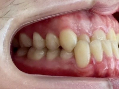 隱形牙套-隱適美Invisalign 隱形牙套-隱適美Invisalign