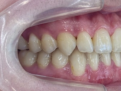 隱形牙套-隱適美Invisalign 隱形牙套-隱適美Invisalign