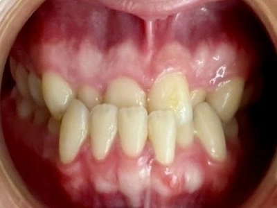 隱形牙套-隱適美Invisalign 隱形牙套-隱適美Invisalign