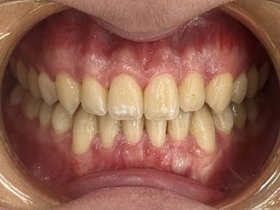 隱形牙套-隱適美Invisalign 隱形牙套-隱適美Invisalign